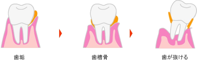 歯周病