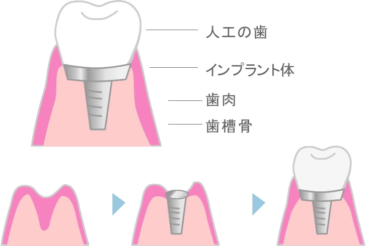 インプラントと骨粗しょう症の関係